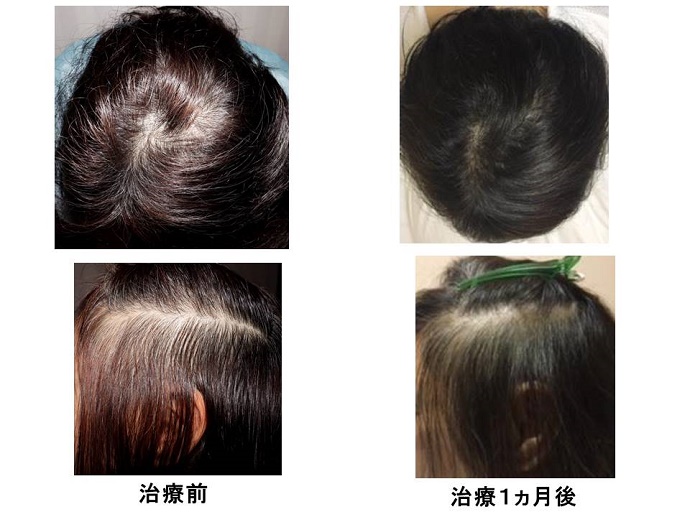 円形脱毛症　病院